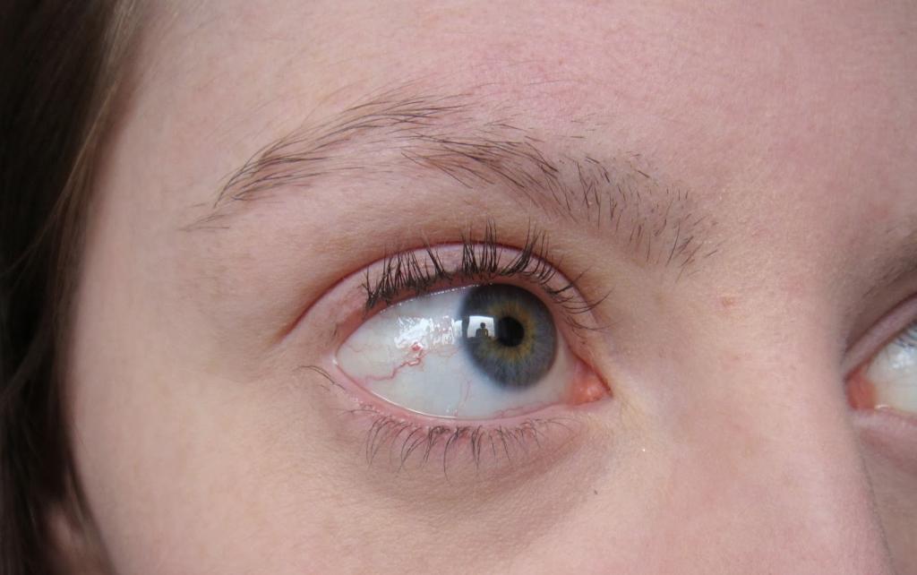 alopecia eyebrow