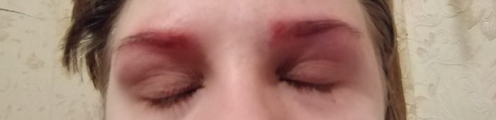 itchy eyebrows