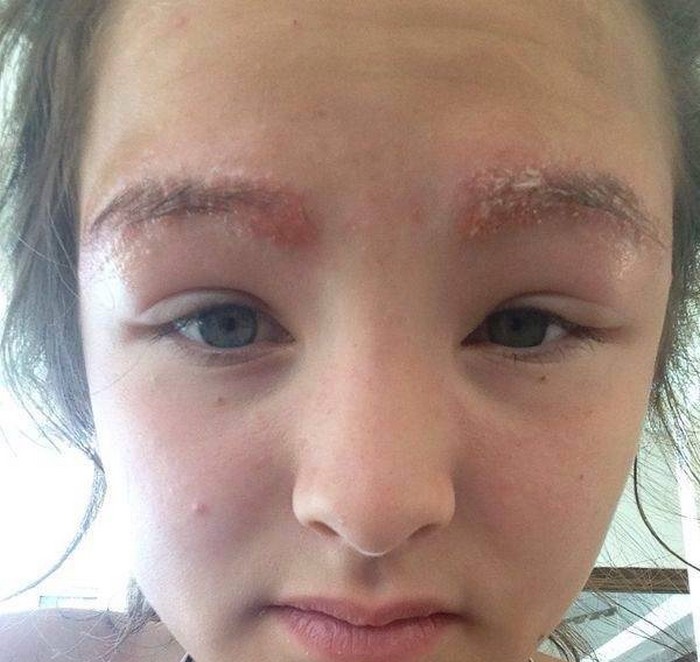 What is the diagnosis and treatment of itchy eyebrows