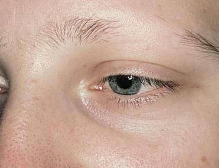 Why the eyebrows itch