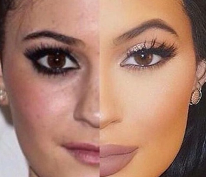 Brow lift with botox before and after photos