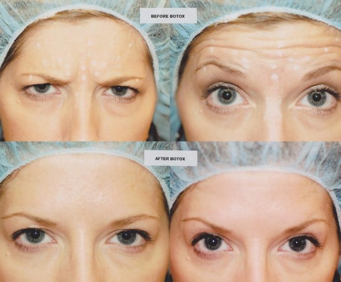 Brow lift with botox before and after photos