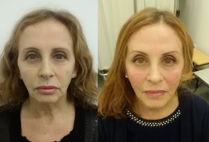 Brow lift with botox before and after photos