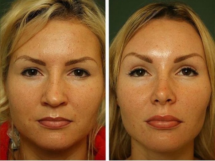 Brow lift with botox before and after photos