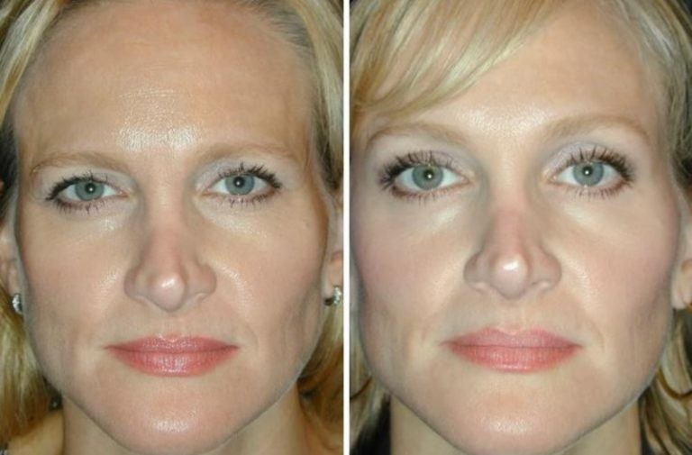Brow lift with botox before and after photos