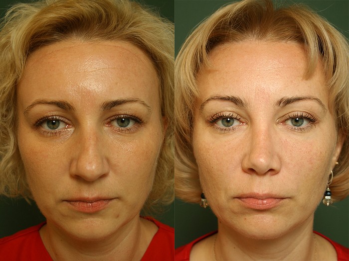 Brow lift with botox before and after photos