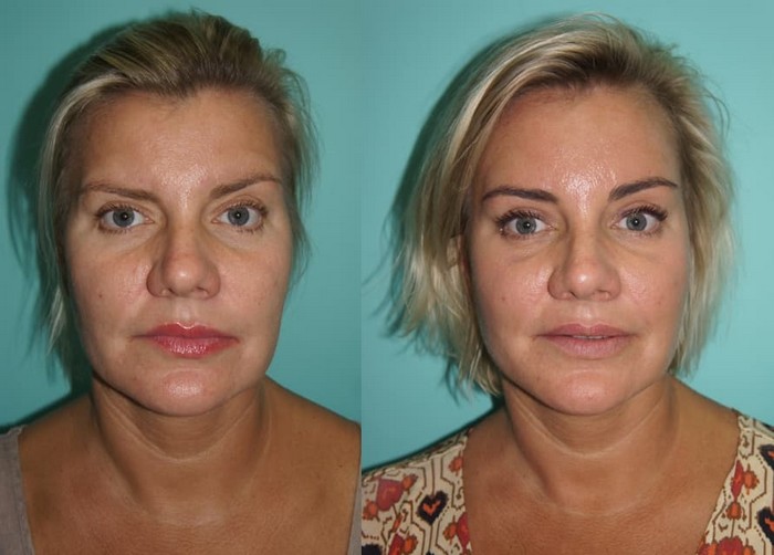 Brow lift with botox before and after photos