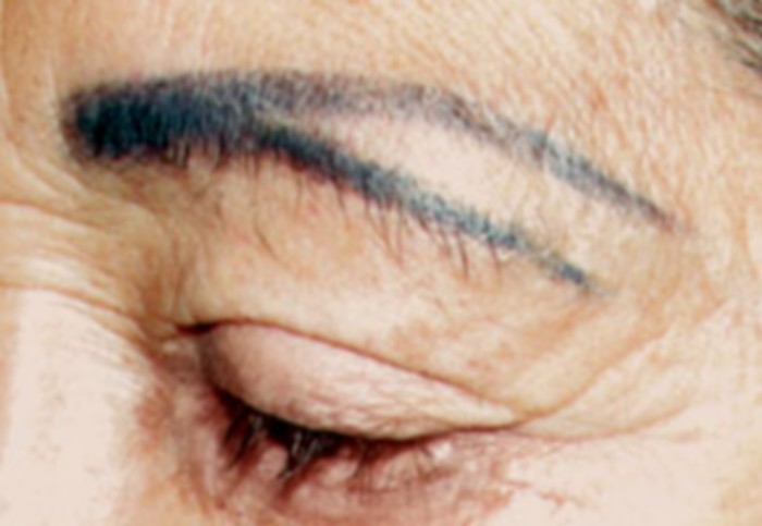 Causes of eyebrow tattoo removal