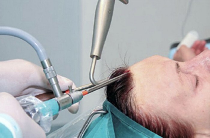 Endoscopic brow lift