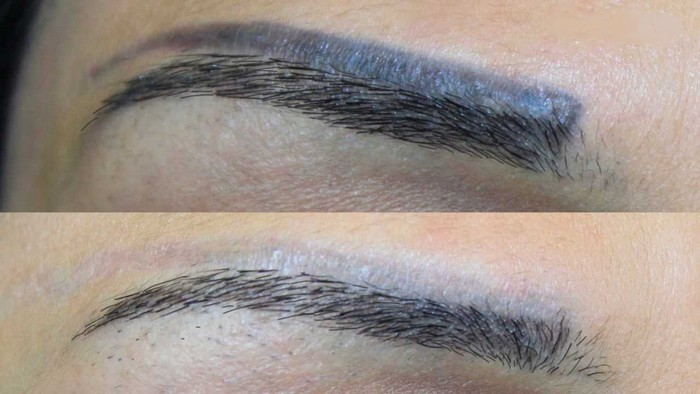 Eyebrow tattoo removal with remover