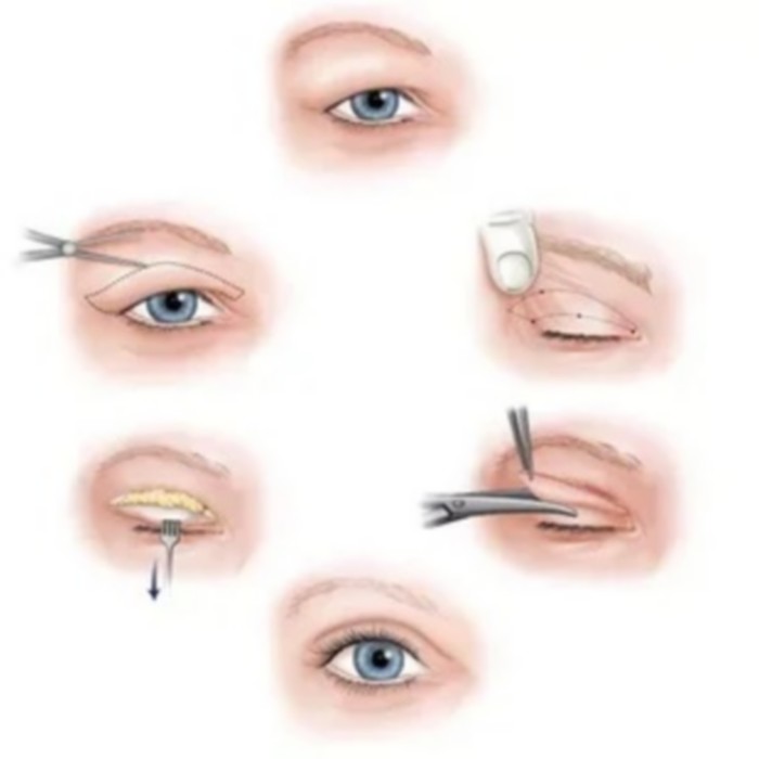 Surgical intervention brow lift