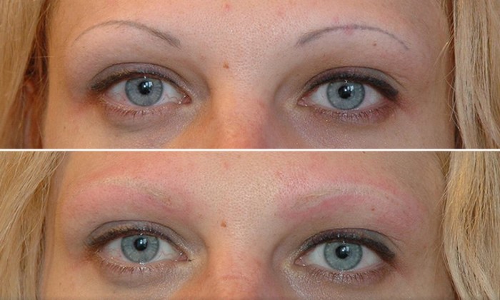 eyebrow tattoo removal laser has certain disadvantages