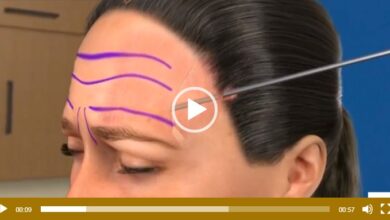 surgical brow lift