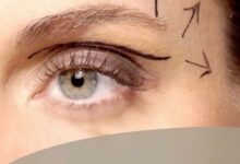 How many units for eyebrow lift