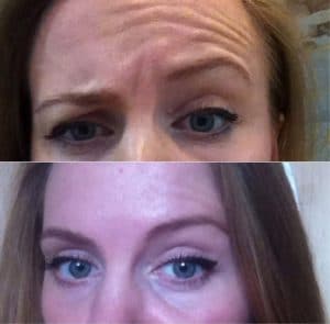 How to fix one eyebrow higher than the other botox?