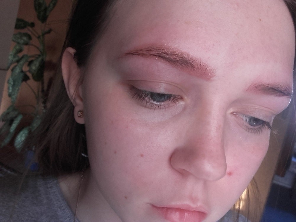 How to reduce swelling by eyebrow?