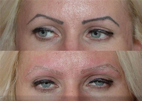 Best Way To Fade Eyebrow Tattoo