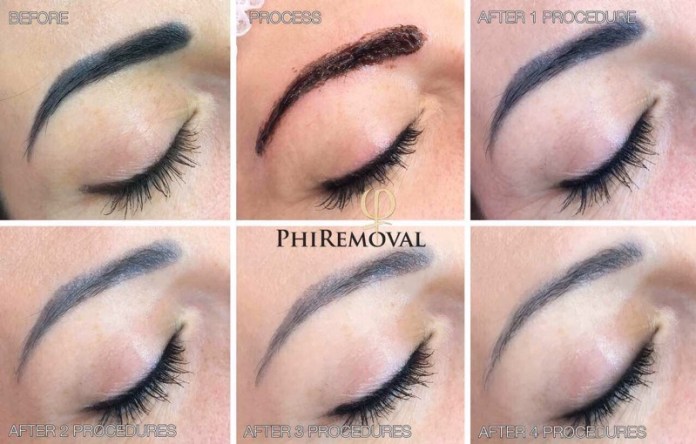 cliomakeup-remove-tattoo-eyebrows-7-eyebrow-removal