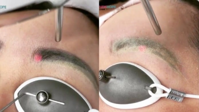 cliomakeup-remove-tattoo-eyebrows-15-laser